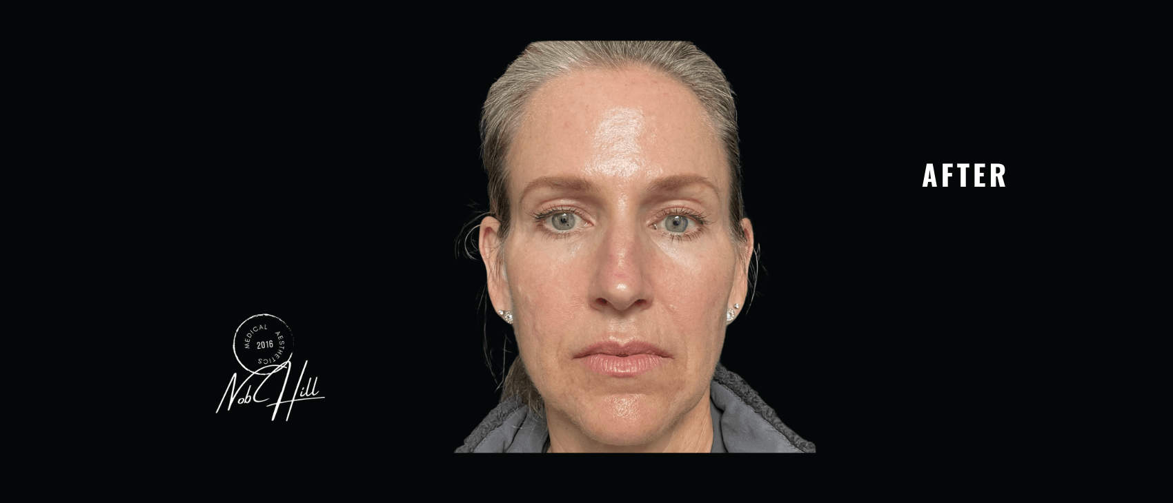 Botox_After - Nob Hill Aesthetics