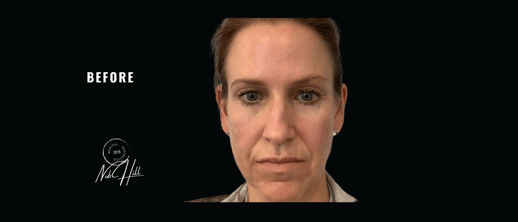Botox_Before - Nob Hill Aesthetics