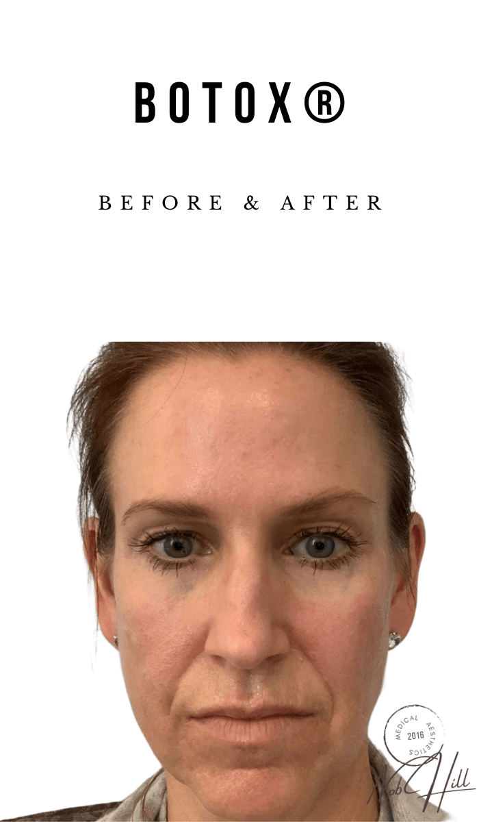 Botox_Before_aed42736-5faa-4351-92be-897488022e3e - Nob Hill Aesthetics 