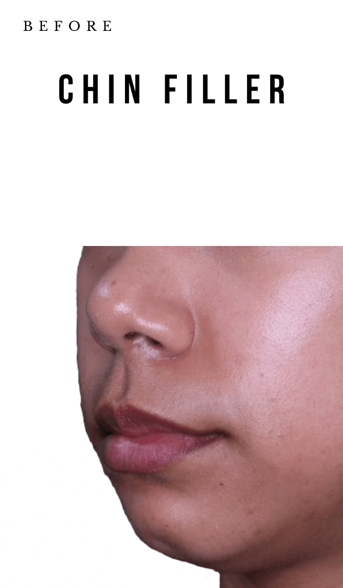 Chin_FIller_Before_Mobile - Nob Hill Aesthetics