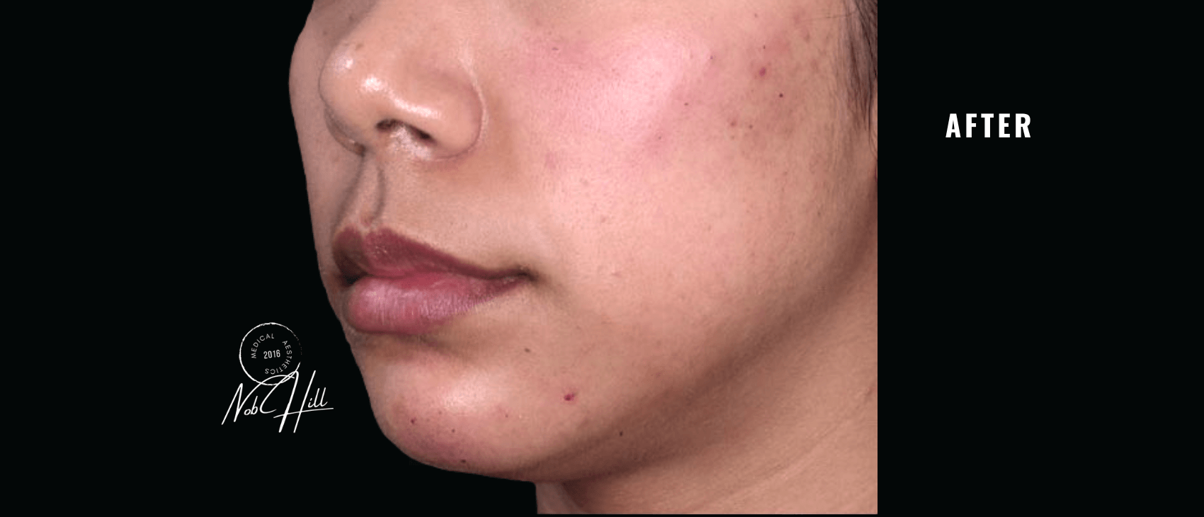 Chin_Filler_After - Nob Hill Aesthetics