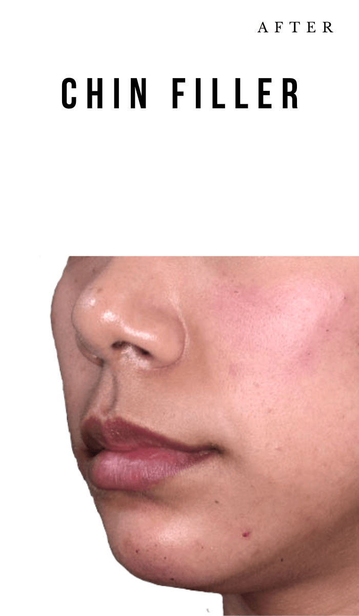 Chin_Filler_Mobile - Nob Hill Aesthetics