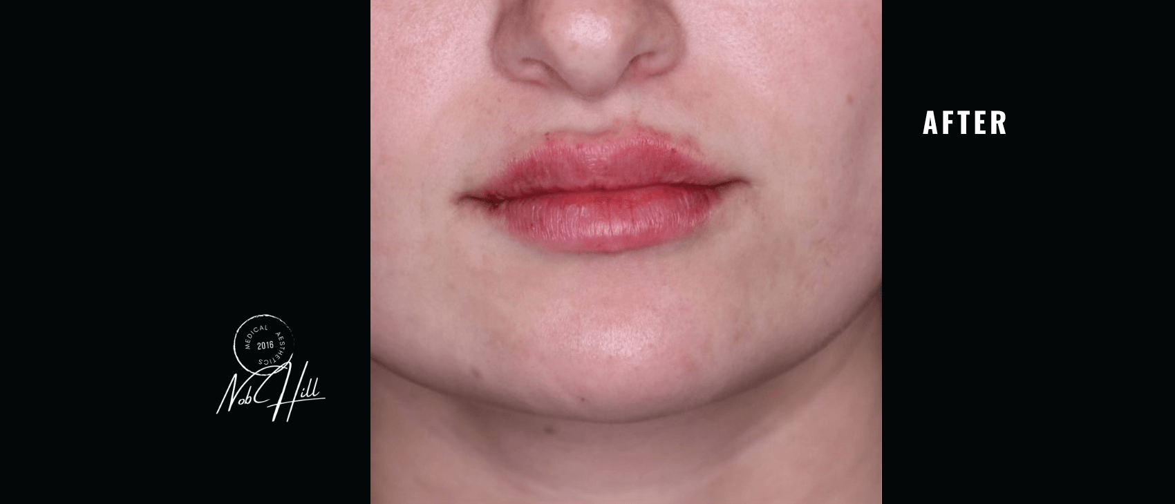 Lip_FIller_After - Nob Hill Aesthetics