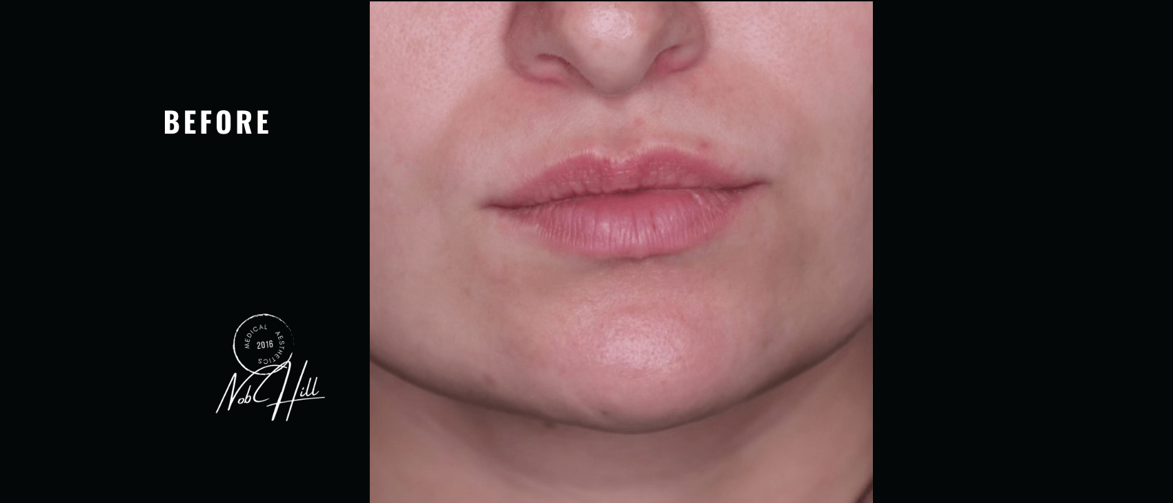 Lip_FIller_Before - Nob Hill Aesthetics 