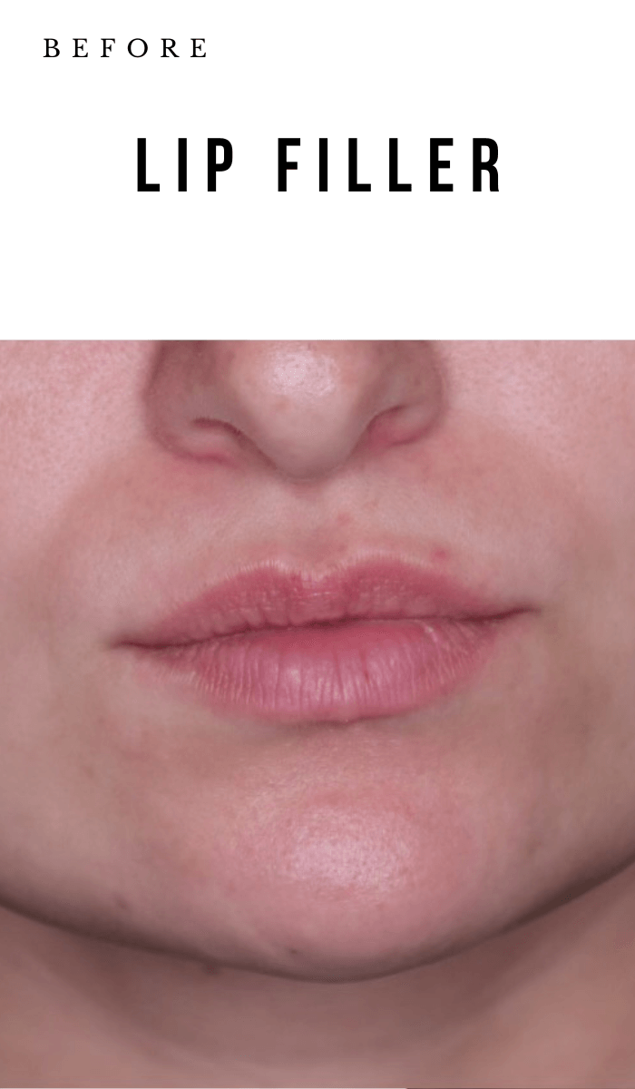 Lip_Filler_Before_Mobile - Nob Hill Aesthetics 